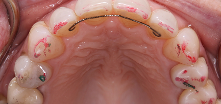 What is occlusal equilibration, and do you need it?