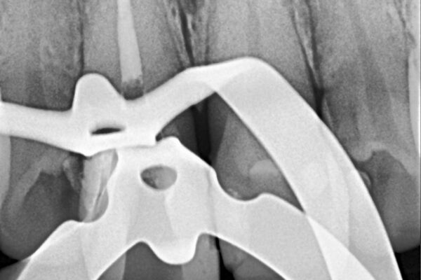 What to expect from your first root canal