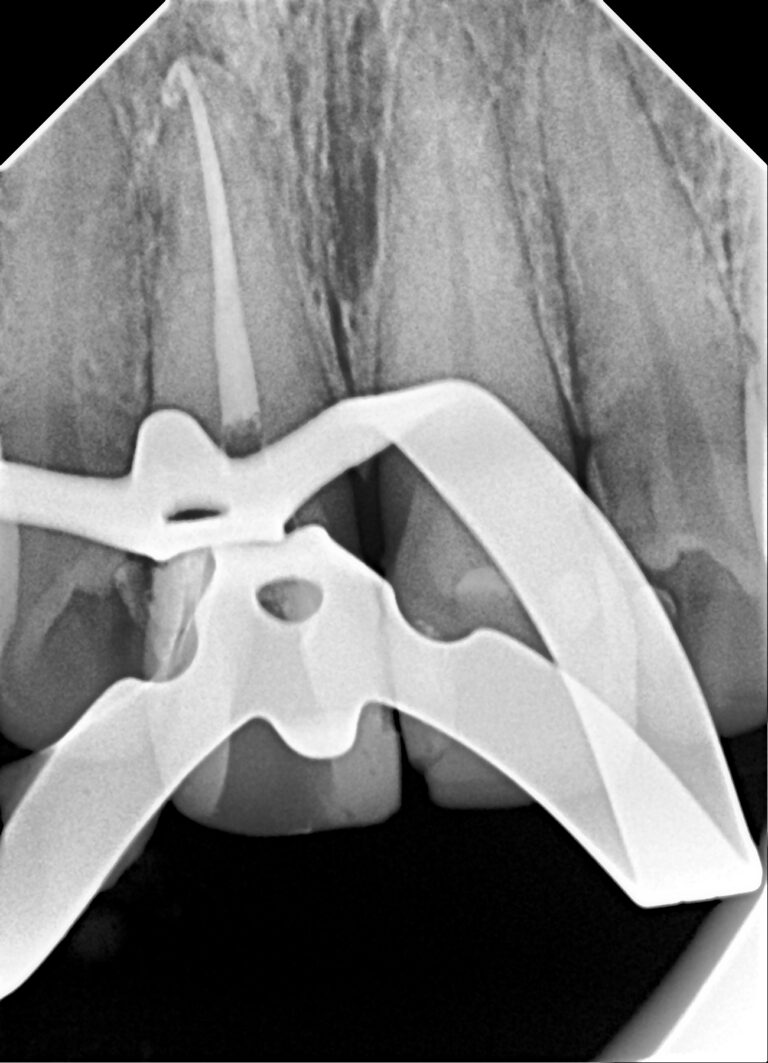 What to expect from your first root canal
